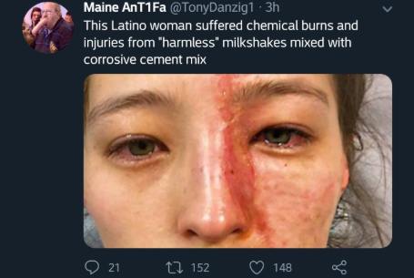 Maine Antifa Chemical Burn Hoax