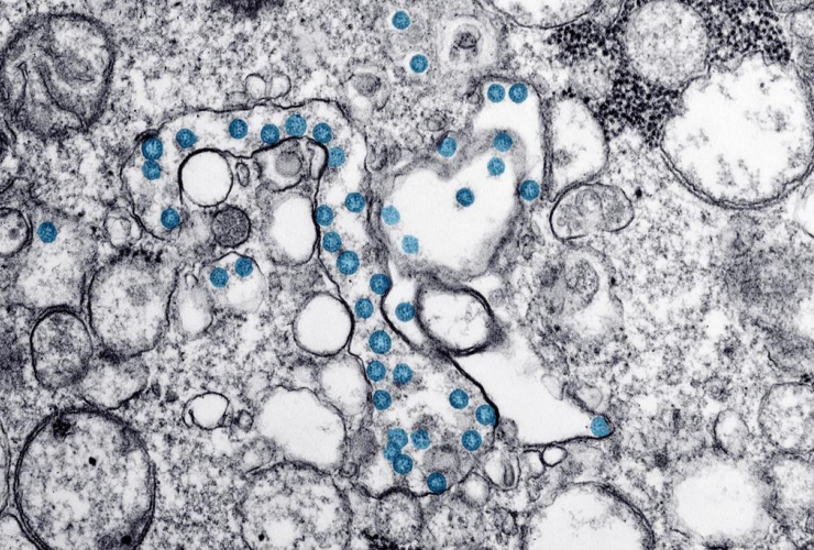 electron microscope image, new coronavirus, colorized blue, 